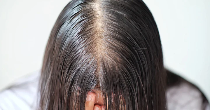 آیا چربی مو باعث ریزش می شود؟