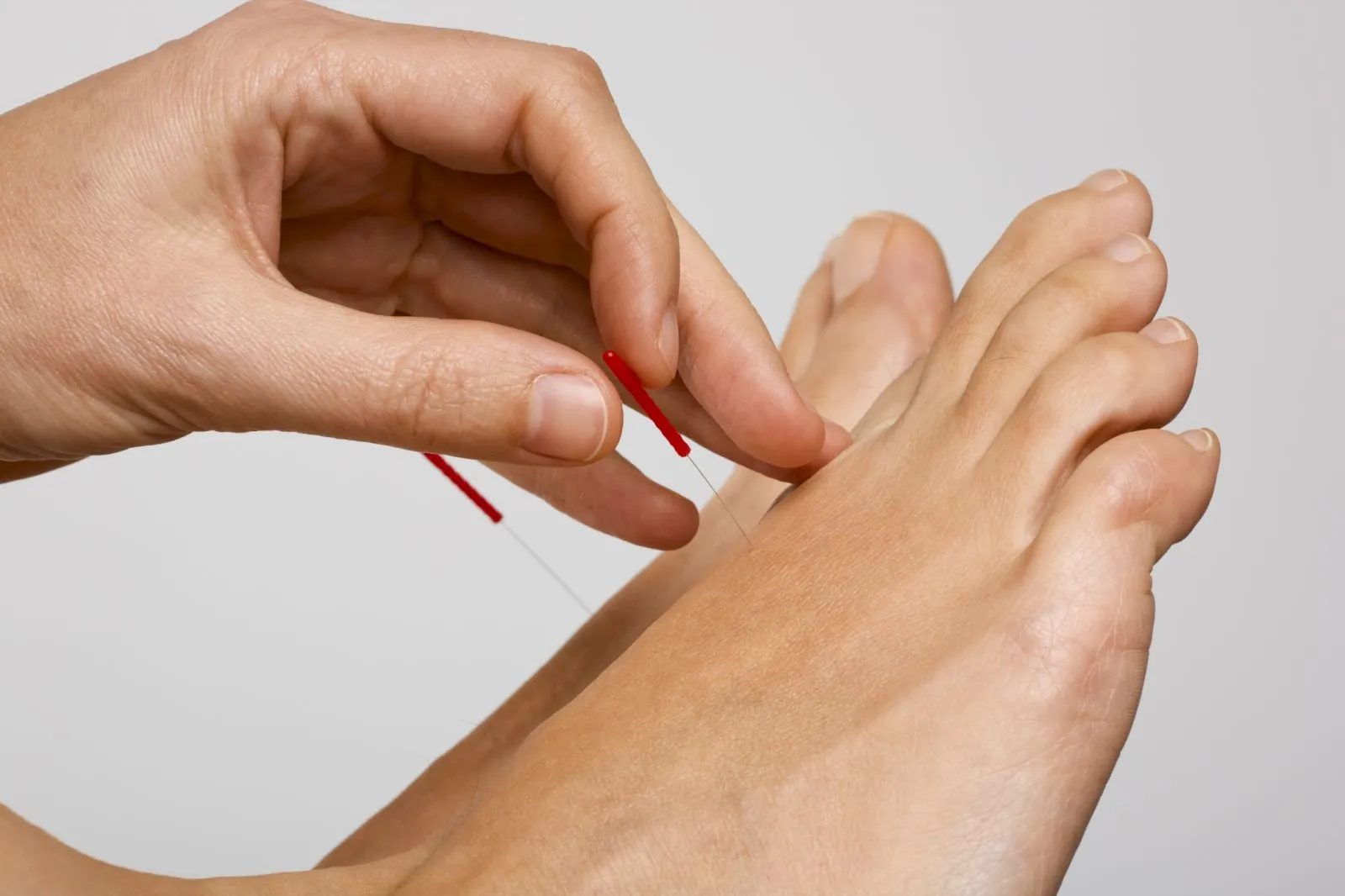 طب سوزنی؛ روشی طبیعی برای کاهش درد آرتروز و بهبود جریان انرژی در بدن