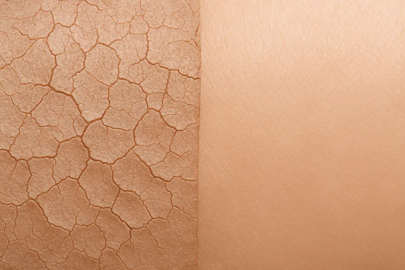 تصویر مقایسه پوست سالم و آسیب‌دیده برای نشان دادن تخریب سد محافظ پوست.