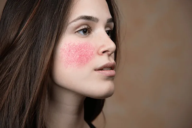 شایع ترین عوارض لیزر موهای زائد