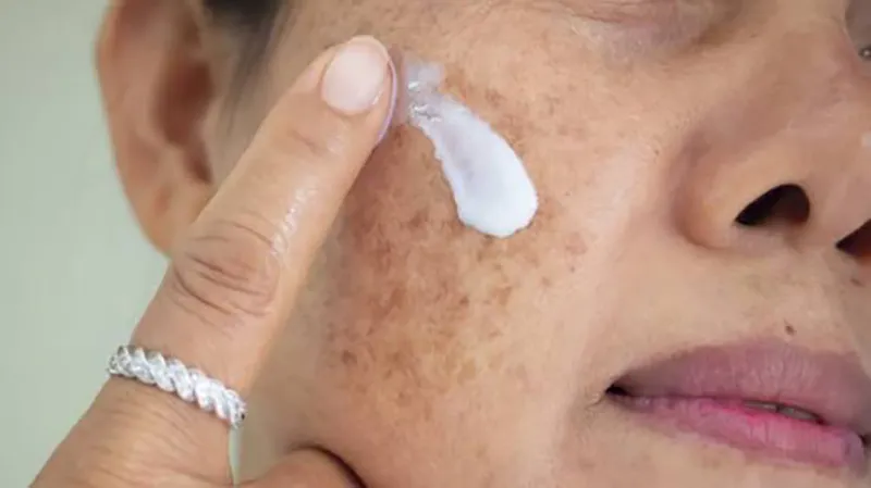 تصویر کرم زدن روی پوست مبتلا به ملاسما